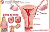 Polyp tử cung là gì? Có nguy hiểm không?